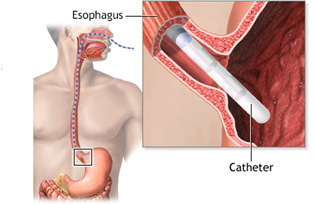 Esophageal Manometry