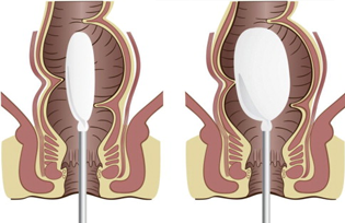 Anorectal Manometry