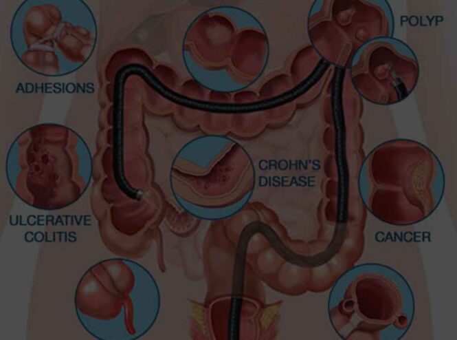 Intenstine